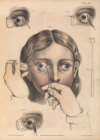 A cover of "eye surgery" cluster. The owner is sdennist. The cluster consists of 33 elements.